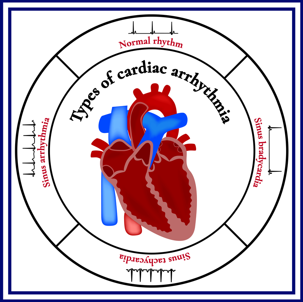 cardiac-arrhythmias-mcvitamins