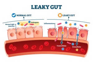 a representation of the leaky gut.