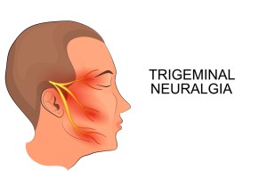 trigeminal pain radiation